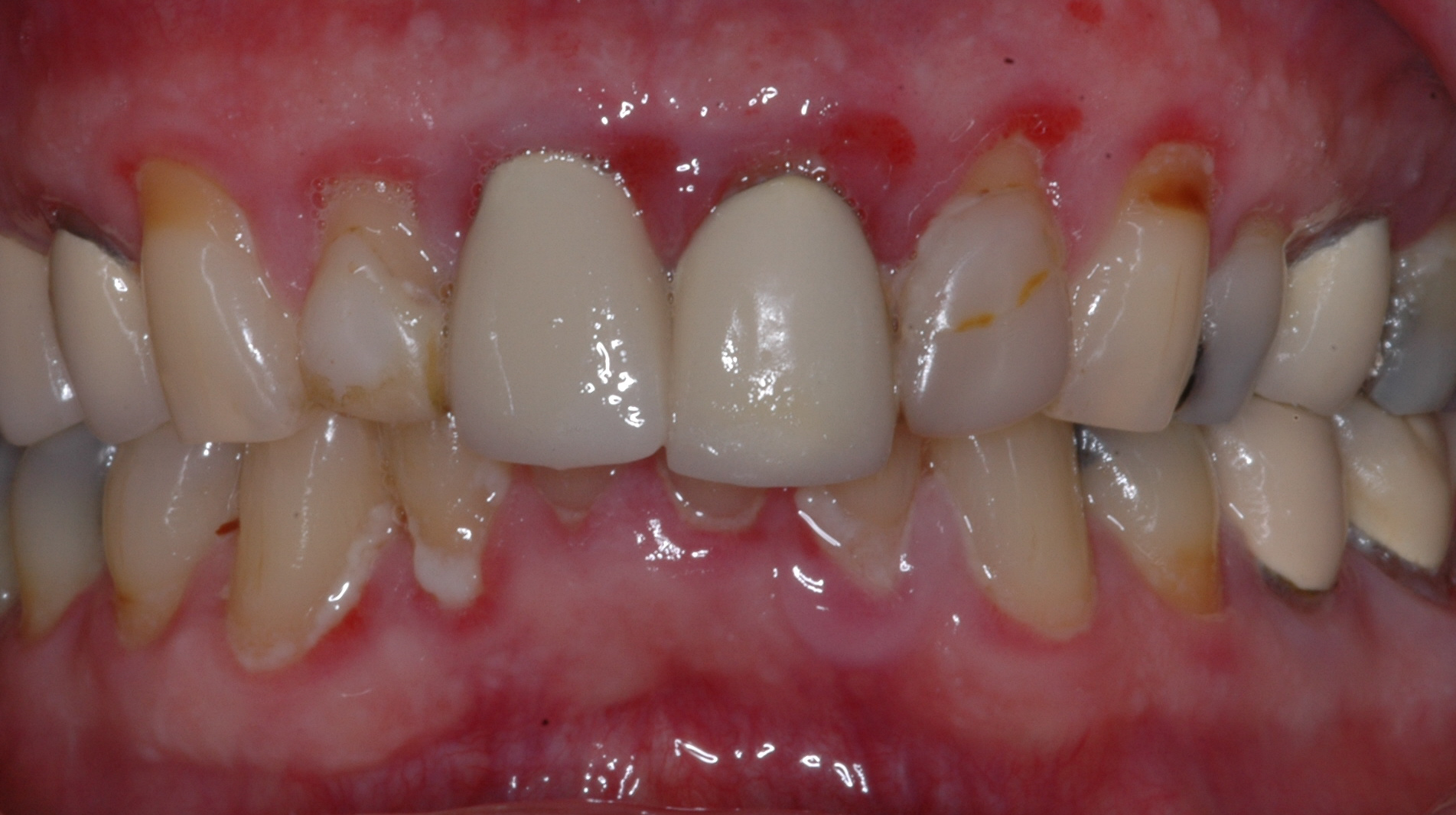  Our 70 year old male patient had quite a bit of inflammation of his tissues and also wanted to improve his smile 