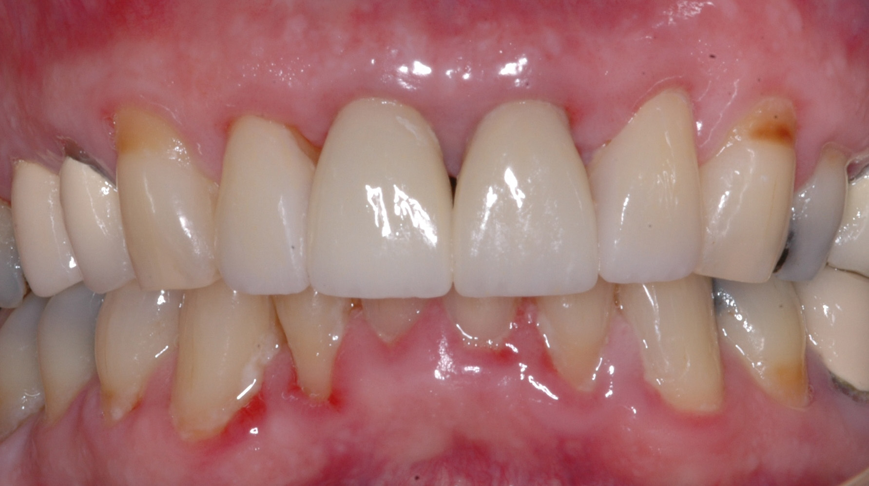  We fabricated crowns on the 4 upper incisors with proper contours, shade, and length.&nbsp; This improved the tissue health around the crowns&nbsp;greatly improving his&nbsp;smile&nbsp; 