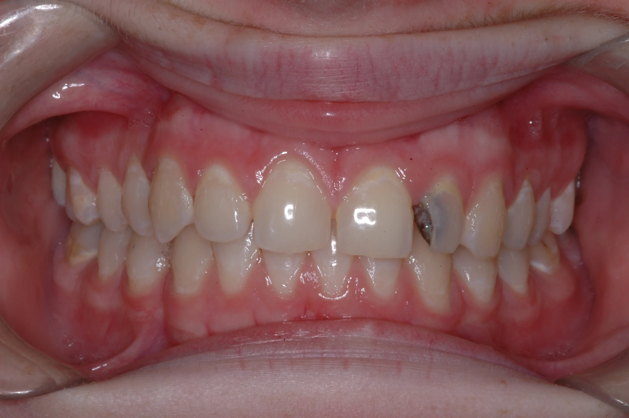 Our patient was an 18 year old female who presented with quite a bit of decay on her left lateral incisor