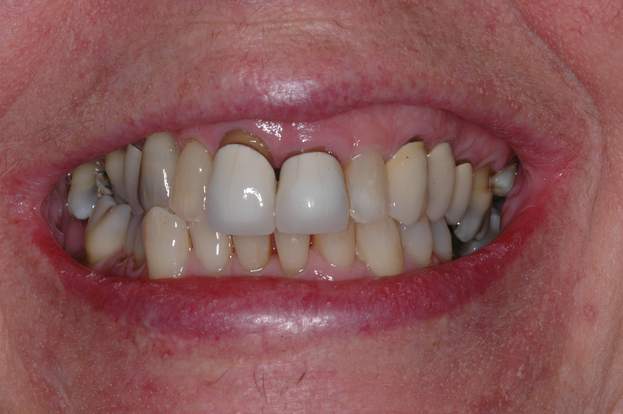  Our patient was a 70 year old female who had crowns on the 2 upper incisors for 30 years. &nbsp;She never liked the esthetics. 