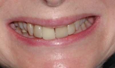  Our patient was a 65 year old female who was experiencing joint discomfort and also desired an improvement in her smile 