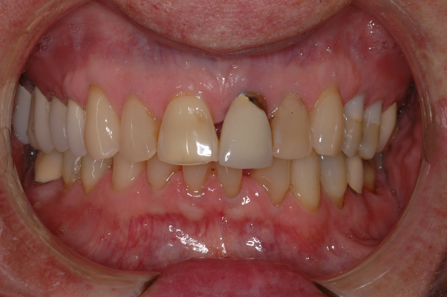  Our patient's left central incisor needed to be removed and had poor esthetics 