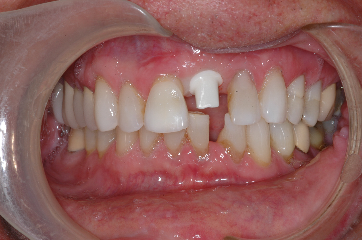  The patient had an implant placed and this is a custom zirconium abutment that will support his crown. 