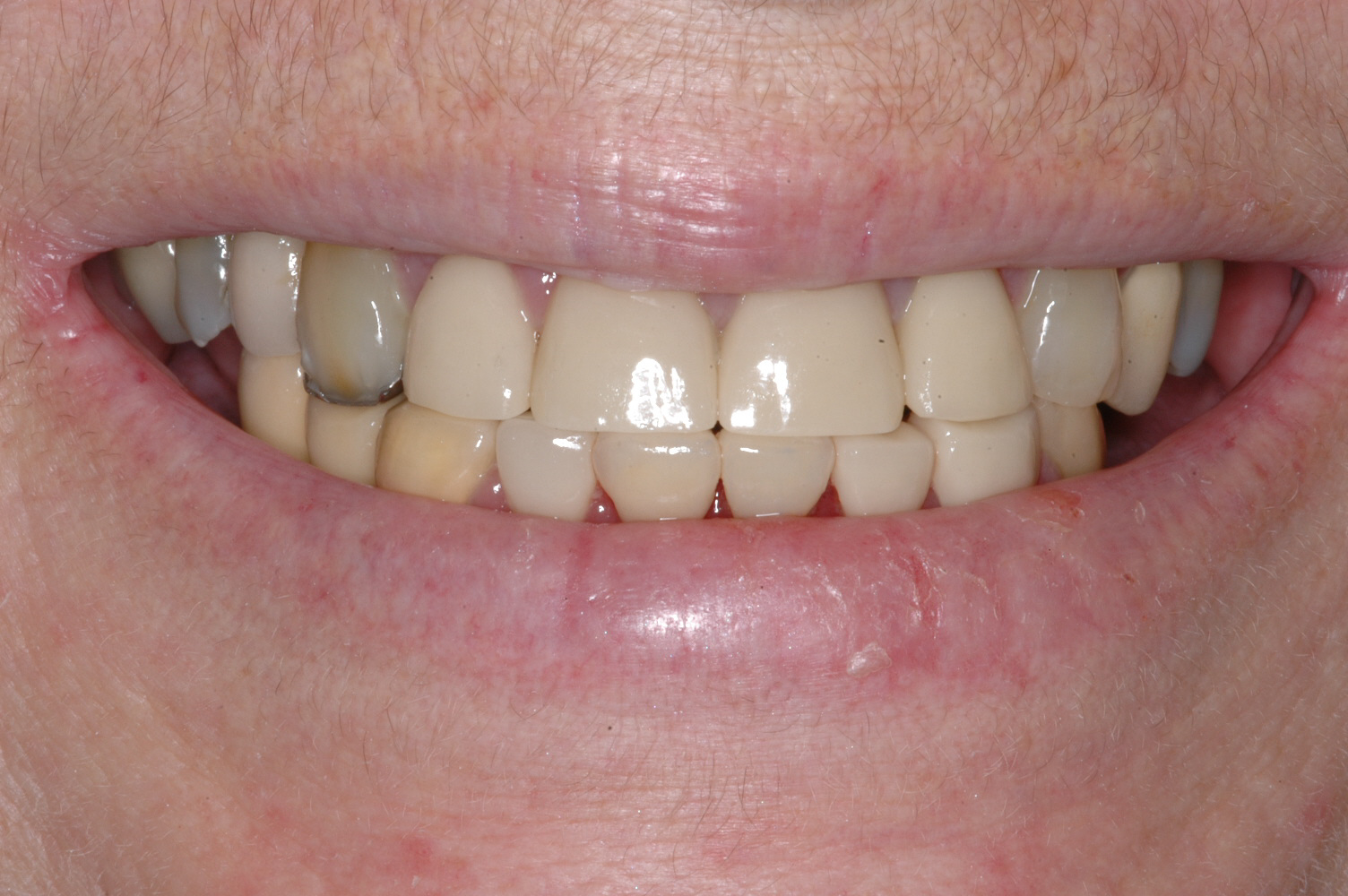  We restored her front teeth with crowns not only improving her esthetics but her function as well 