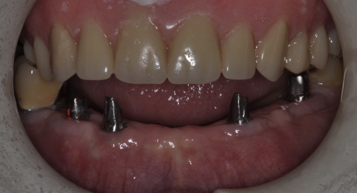  We restored the area using 4 implants and 4 custom abutments. 