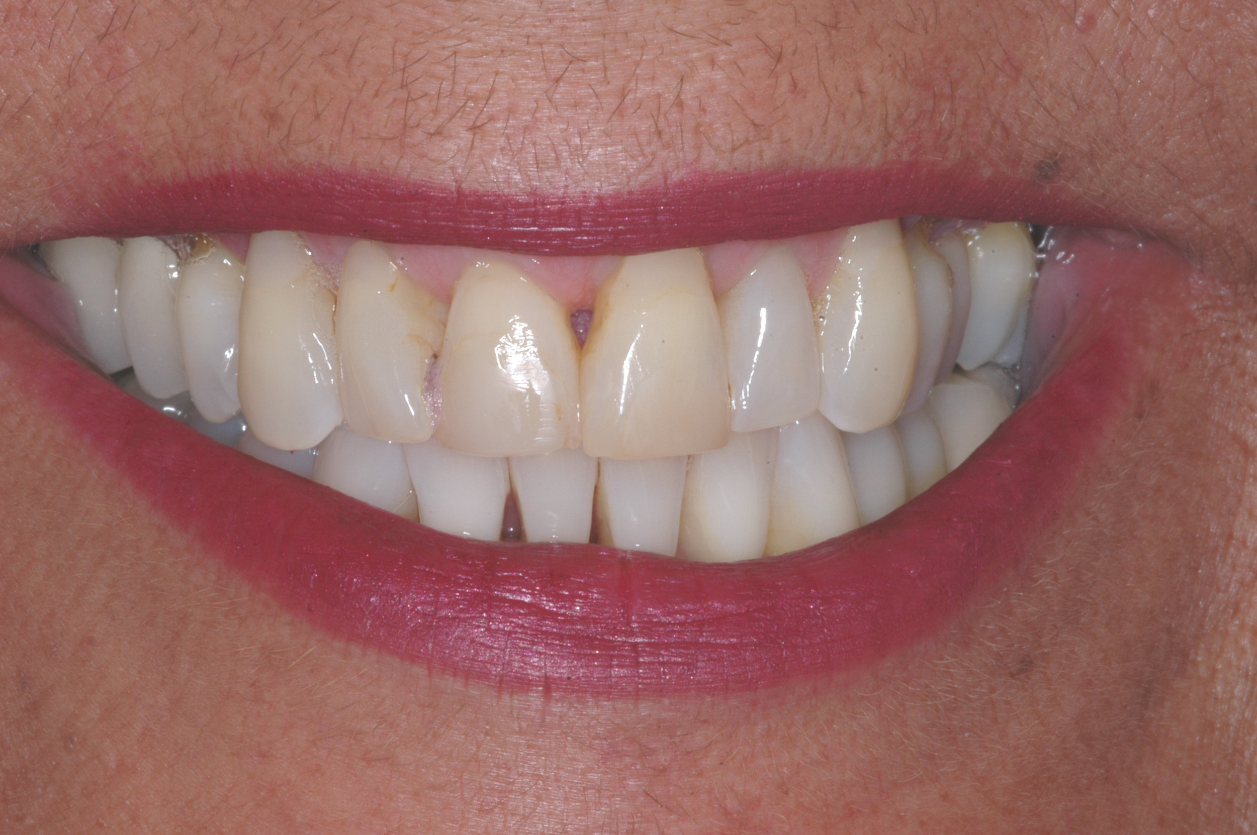 Our patient was a 62 year old female who desired an improvement in the esthetics of her smile