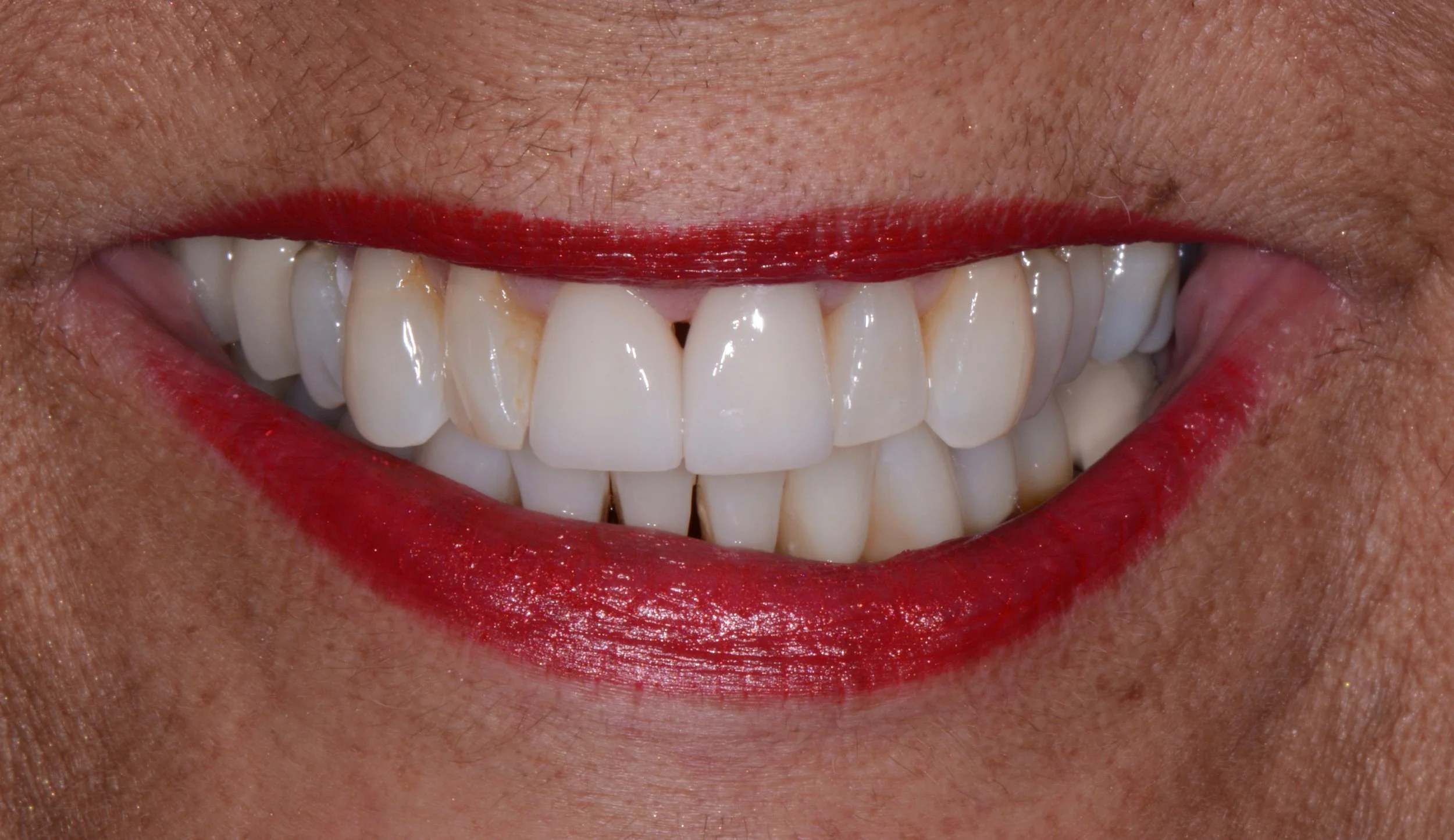 After Zoom in-office whitening, We restored the two central incisors which previously had discolored bonding. The patient loved the result.