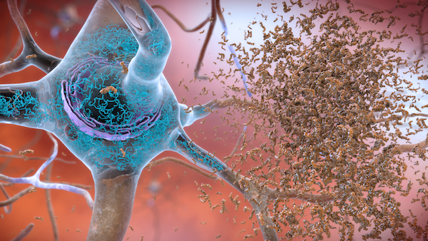 Beta Amyloid Plaques banner.png