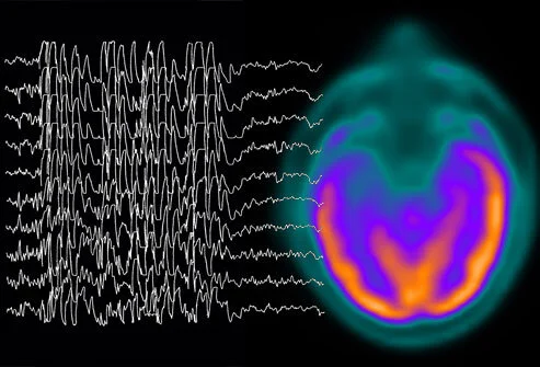 epilepsy banner.jpg