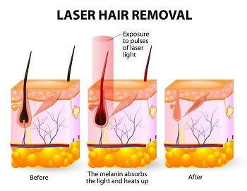 laser_hair_removal_how_it_works.jpg