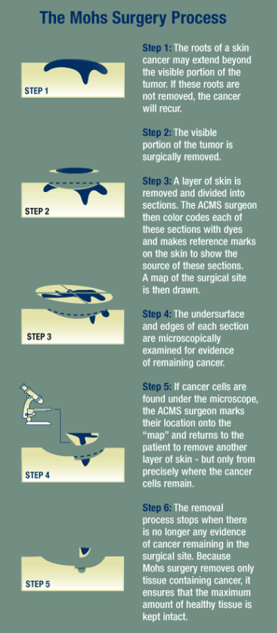 Infographic: How does Mohs surgery work?