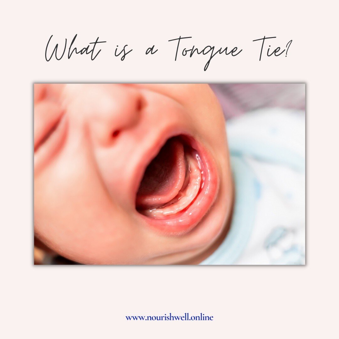 What is a tongue tie? Almost all infants are born with lingual frenulums (a fold of mucous membrane under the base of the tongue that helps to anchor the tongue in the mouth). Frenulum thickness, elasticity and where it is attached to the tongue and 