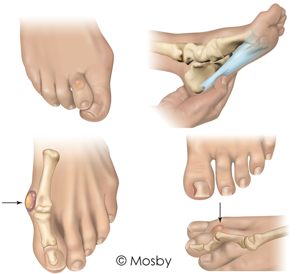 bunions and corns.jpg