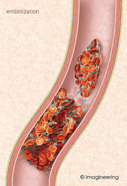 embolizing.jpg