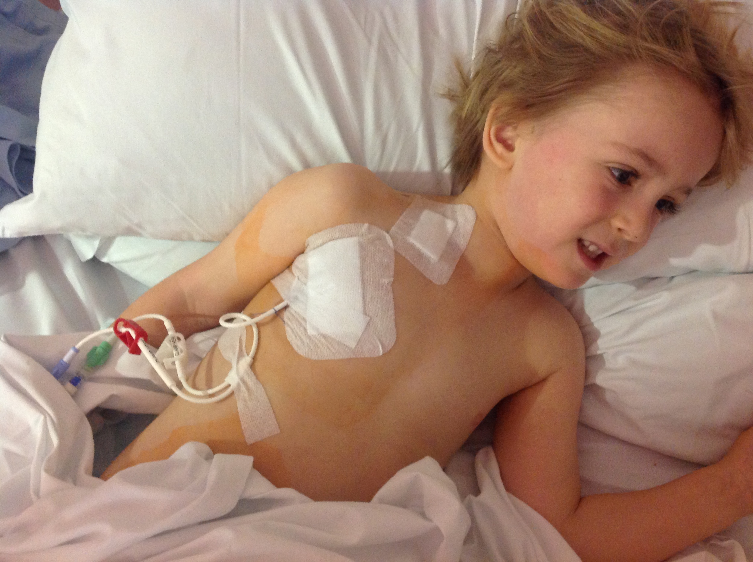 Hickman Line - vascular catheter inserted directly into the heart to maximise flow of drugs around the body.