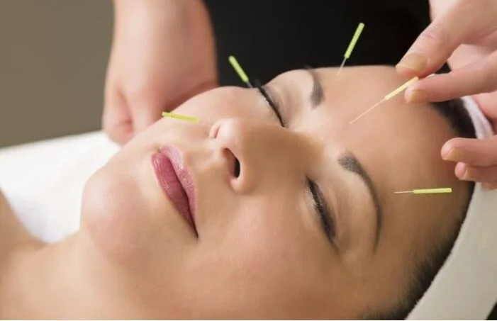 What is facial acupuncture &amp; why do celebs swear by it?