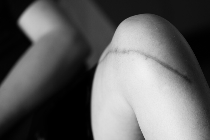 Scar Stories Andrew Osteosarcoma by Lisa Auger.jpg