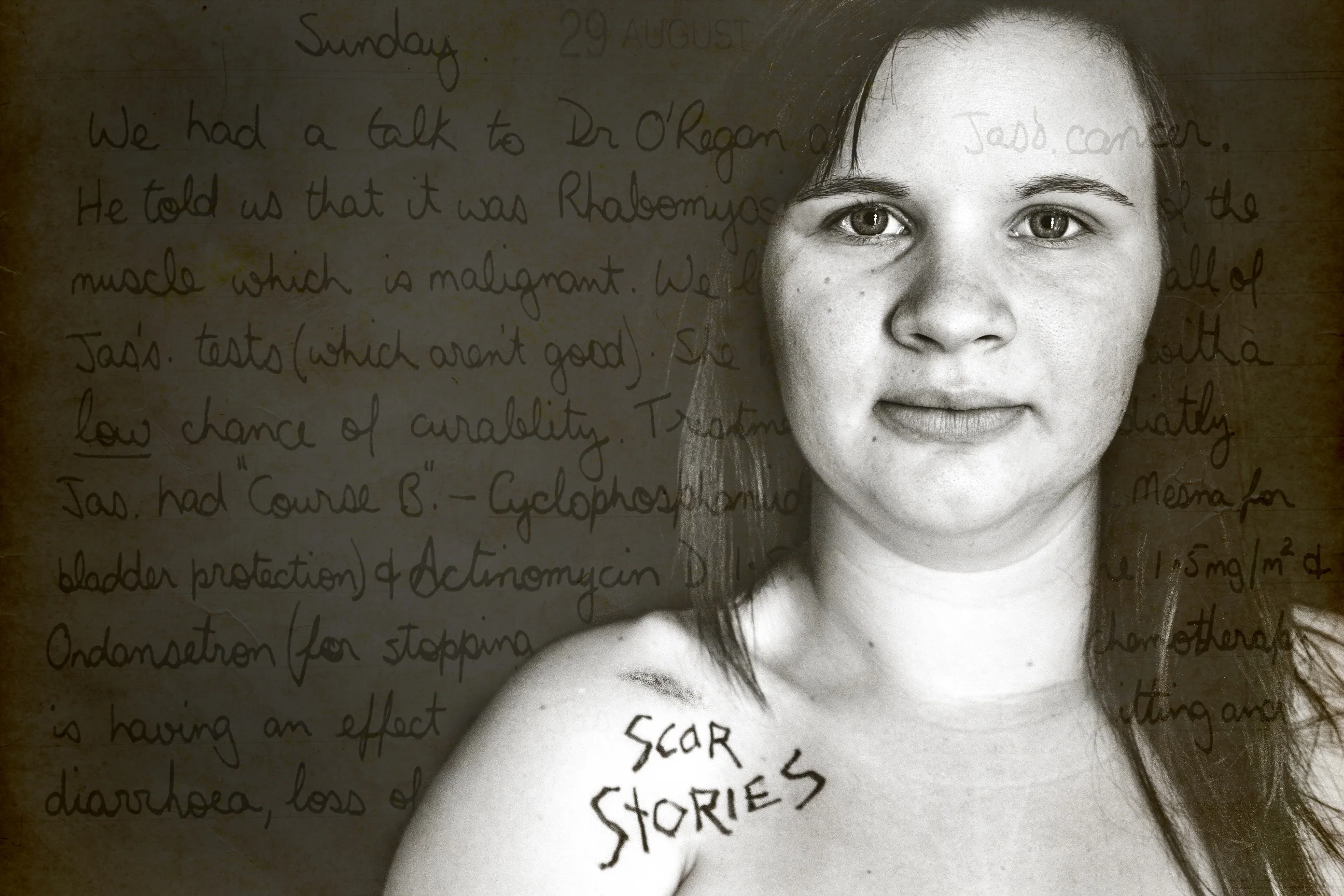 Jas, Rhabdomyosarcoma by Charmaine Lyons