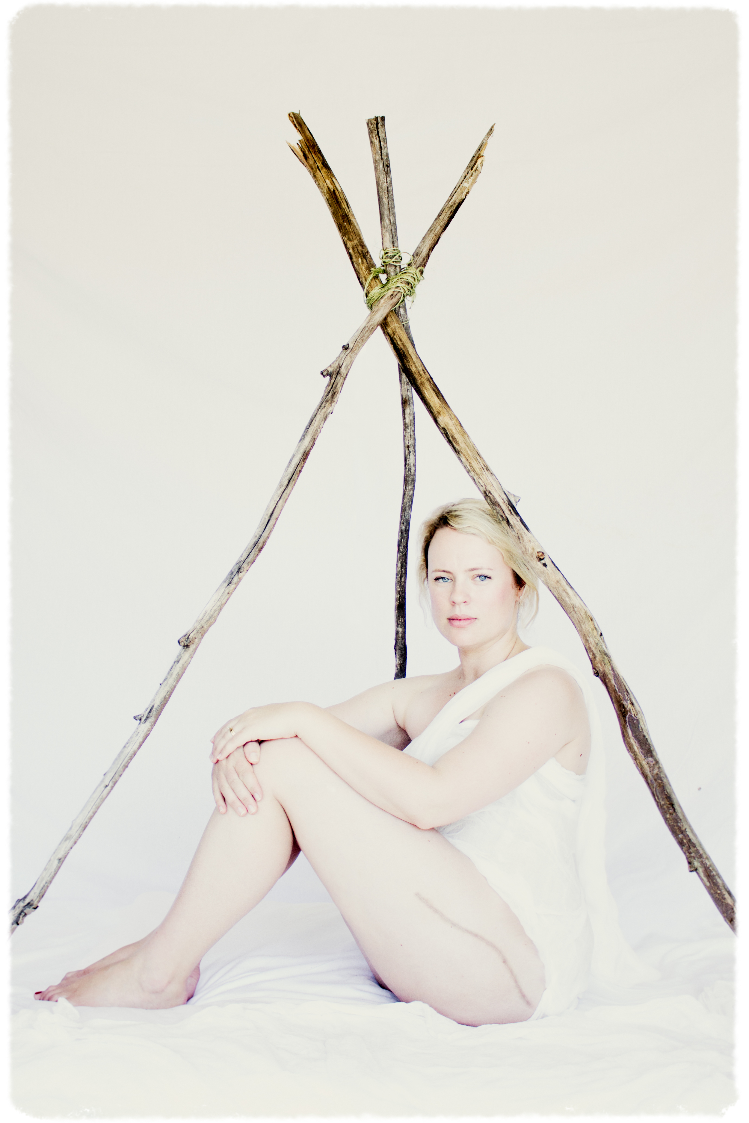 Sarah, Chondrosarcoma, Scar Stories by Charmaine Lyons