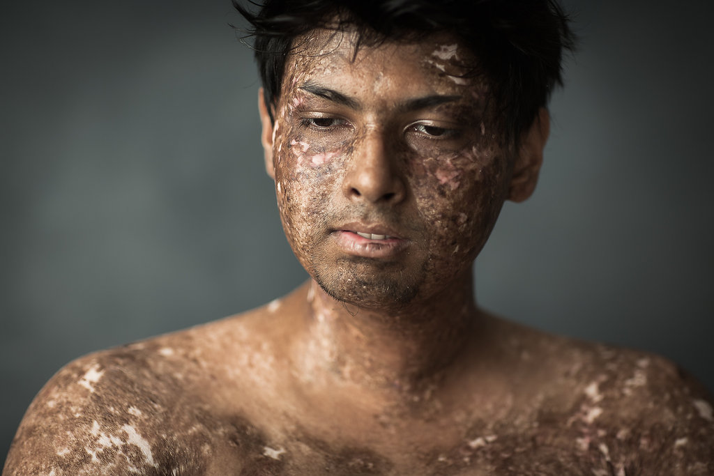 ScarStoriesNikhilAutar6AnaliaPainoPhotographer.jpg