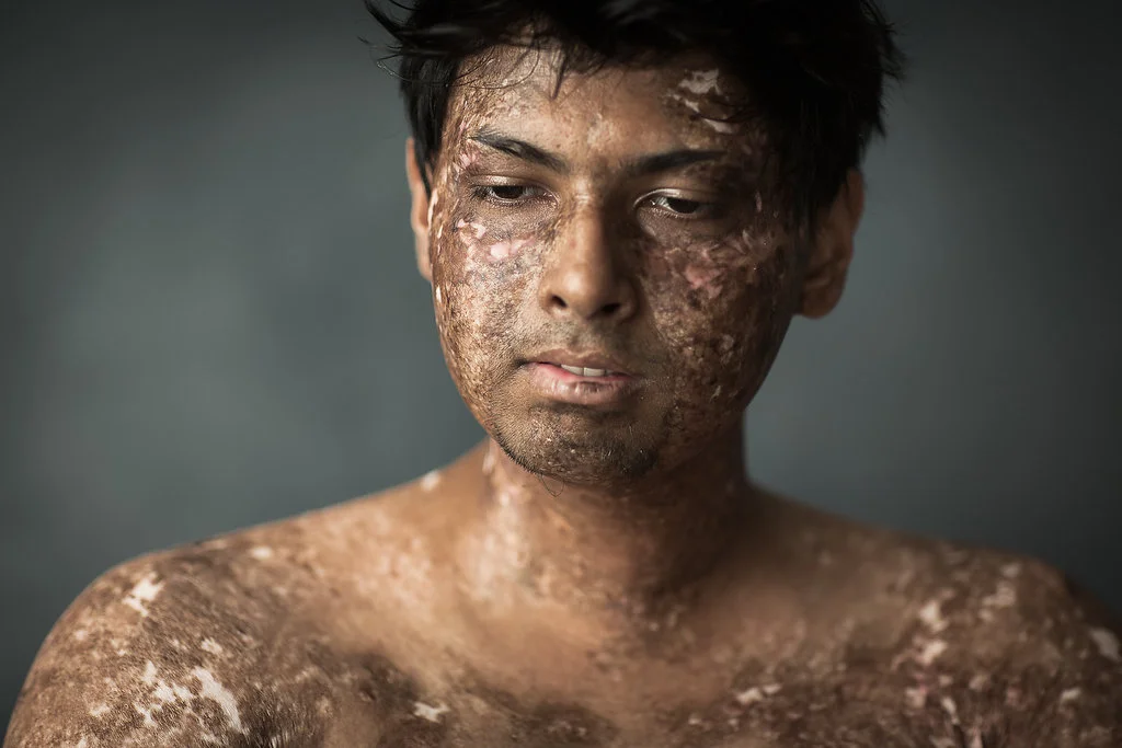 Nikhil, Leukaemia, by Analia Paino