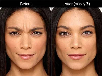 botox-before-and-after-photo.jpg