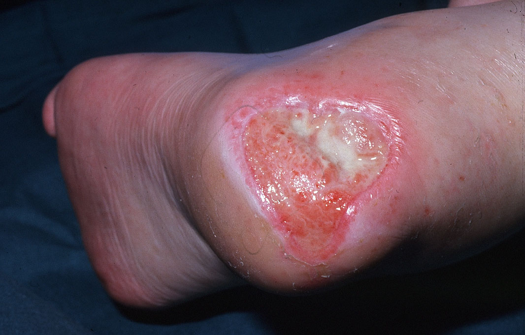 Heel ulcers can be prevented with appropriate pressure relief