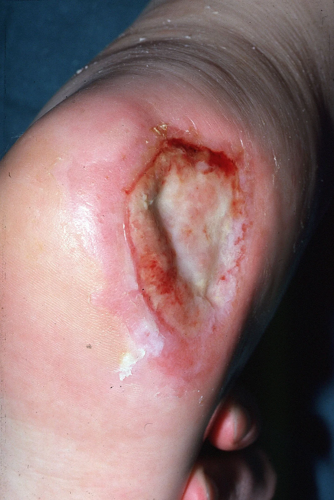 Heel ulcers are a common problem