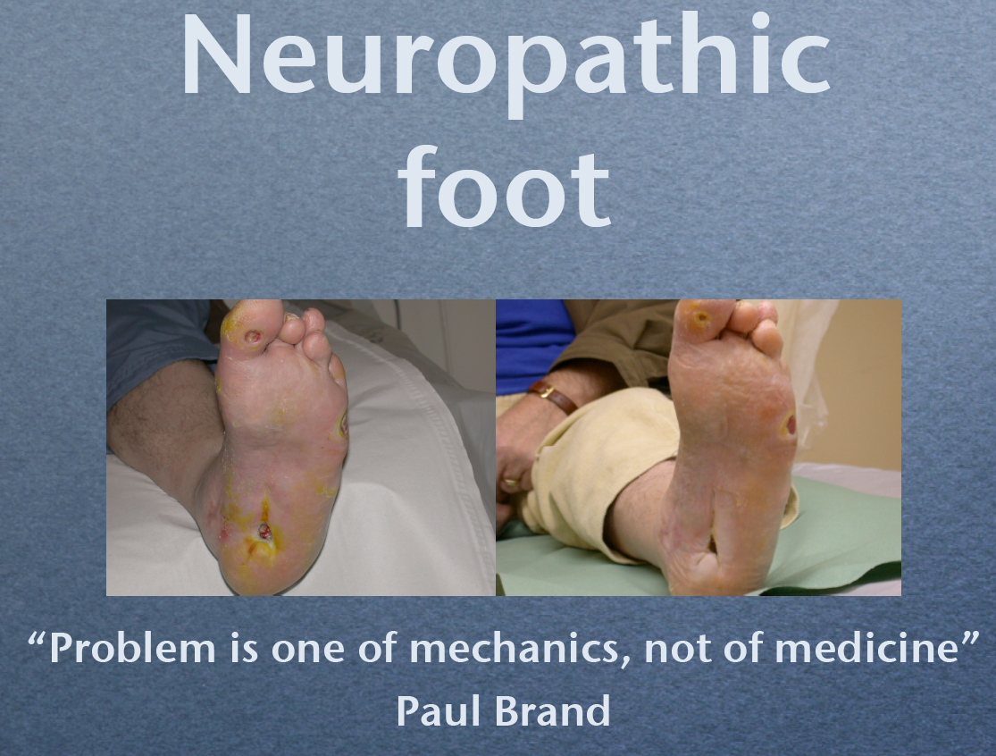 True - not just for the diabetic foot