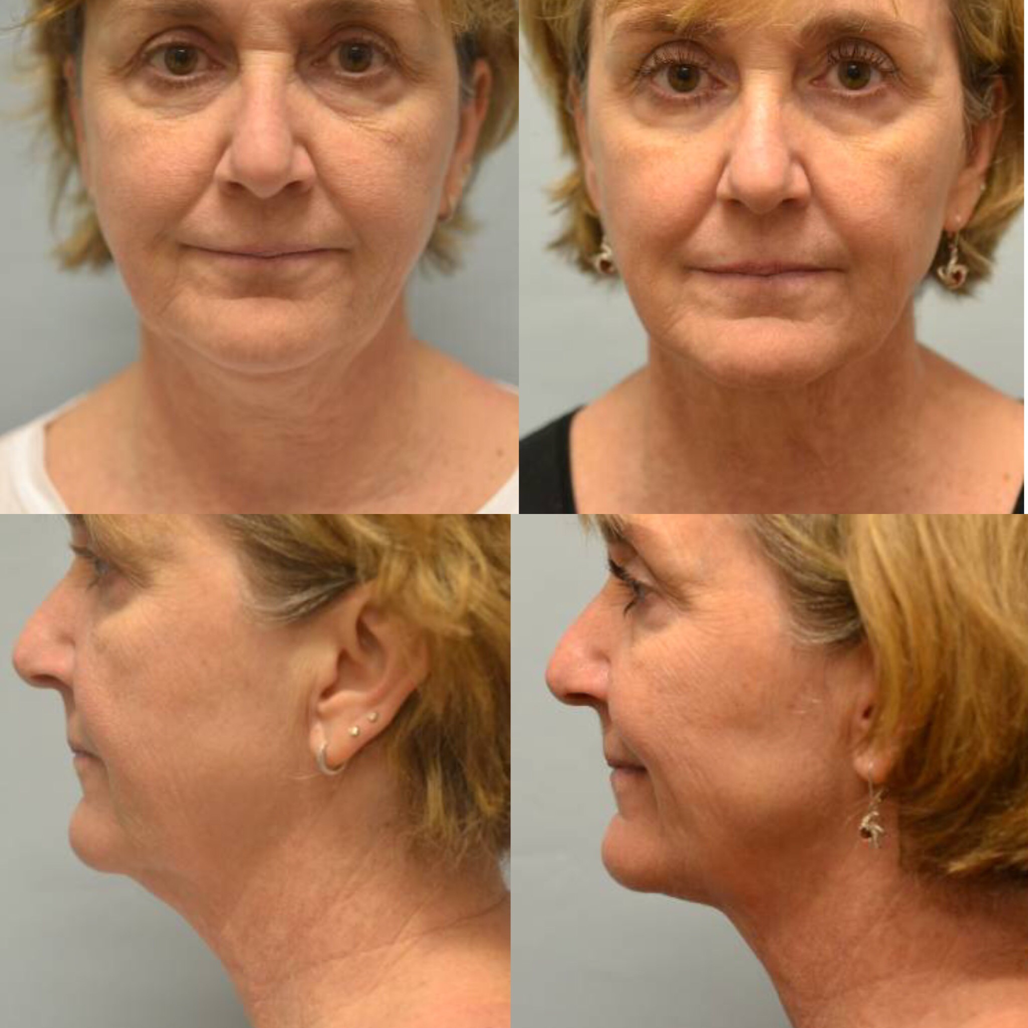Ultherapy of the neck and lower face