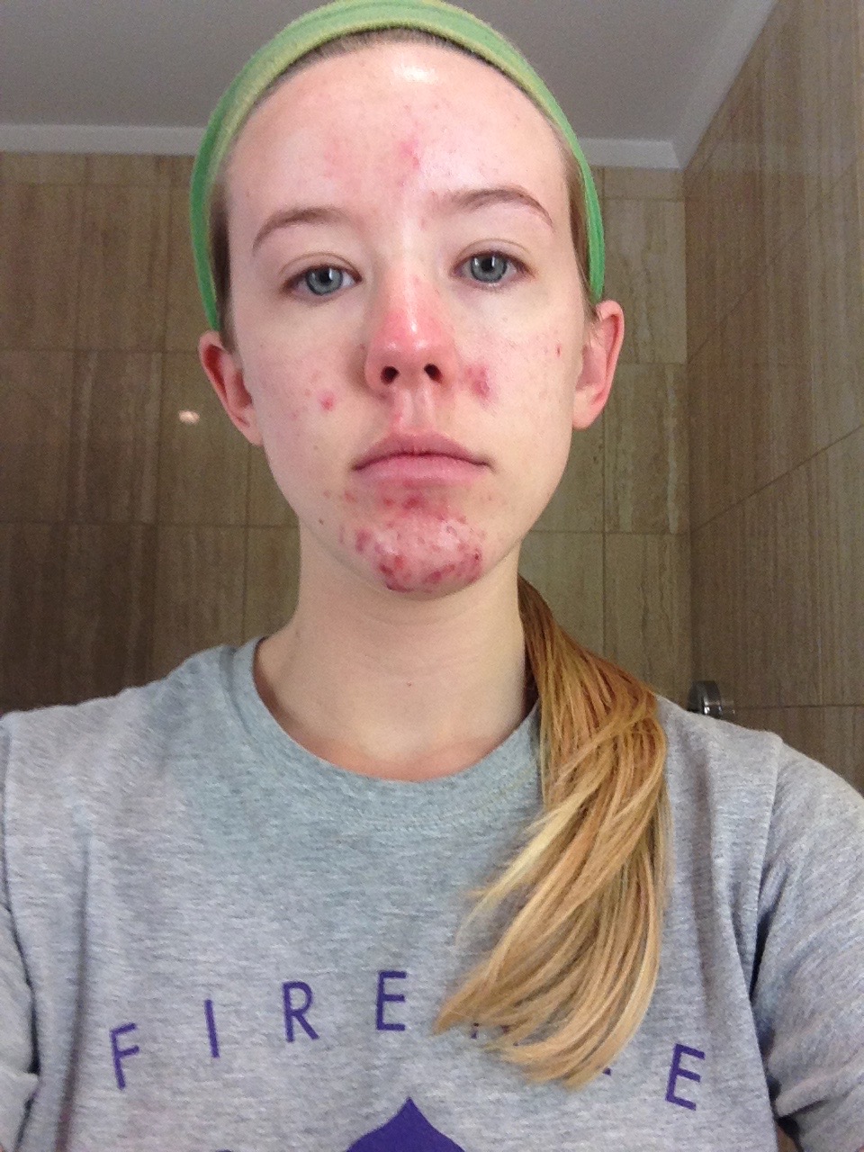 birth control and acne reddit