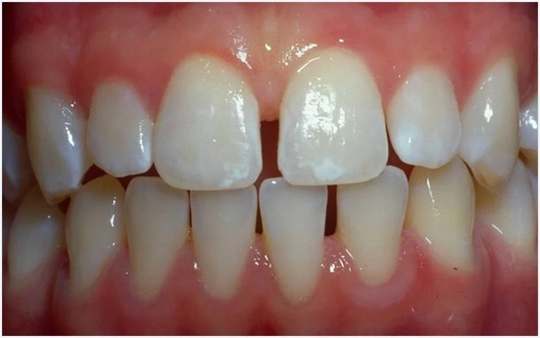 Diastema-Before.jpg