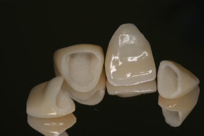 Full Ceramic Crowns