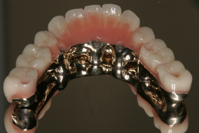 Custom made implant replacement of all teeth