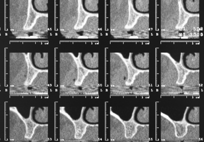Cone Beam CT SCANS