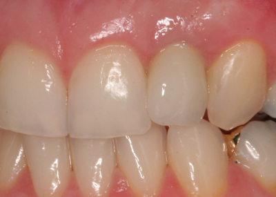 Crown replacing front tooth
