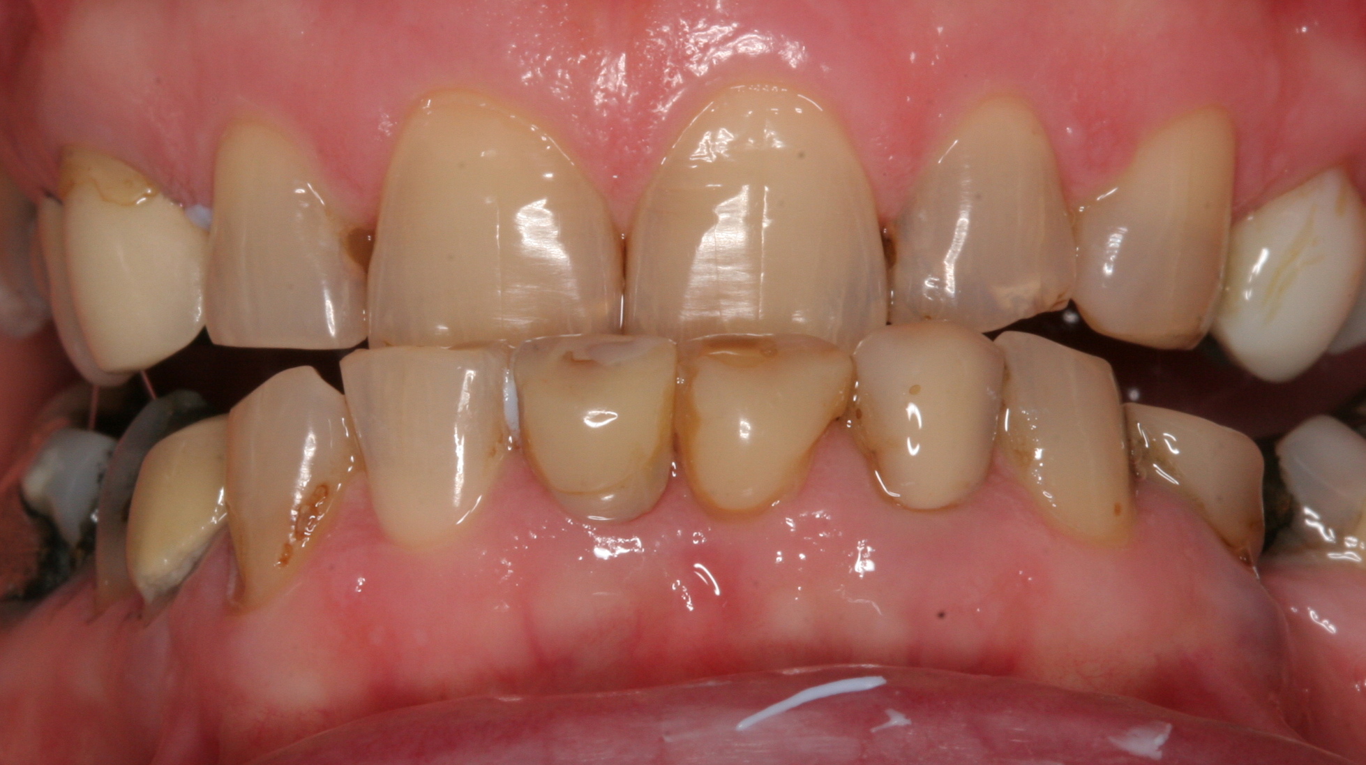 Worn discoloured broken teeth