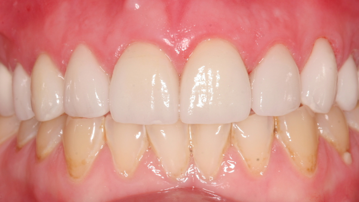 Rebuilt with ceramic crowns