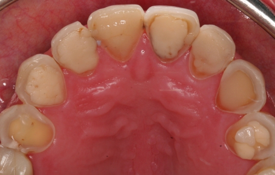 Eroded & worn teeth