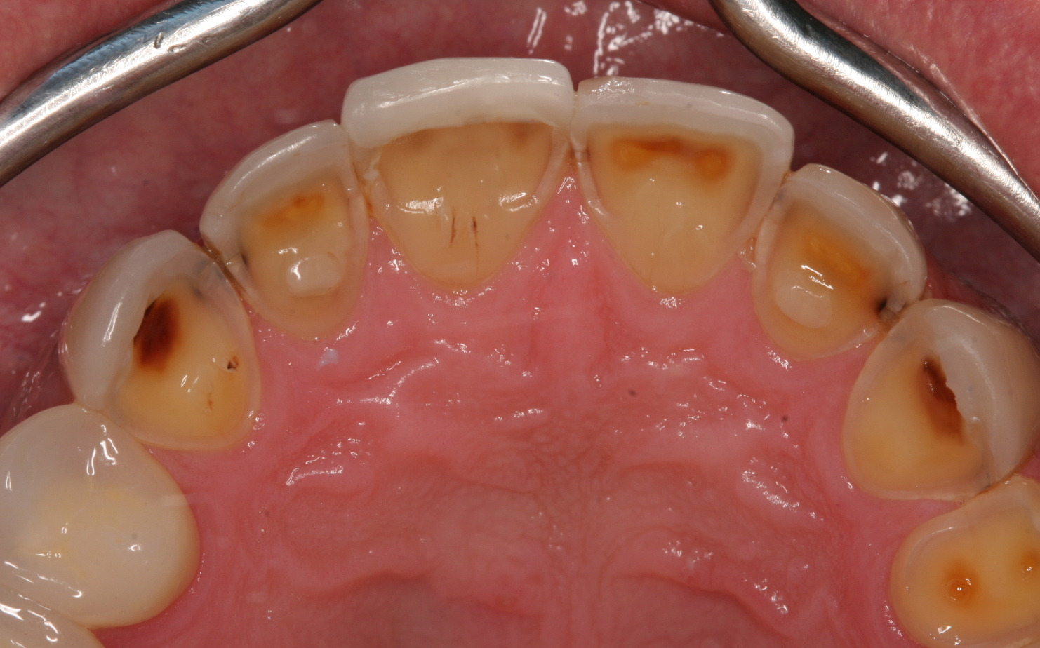 Erosion behind broken old veneers