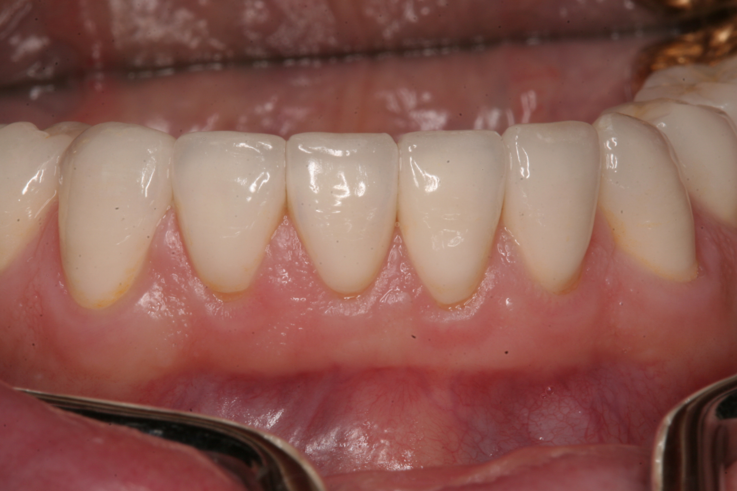 Reconstucted lower teeth