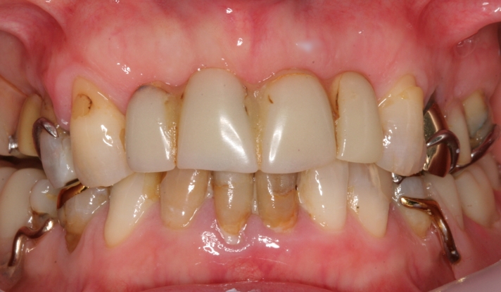 Poorly fitting Old dentures