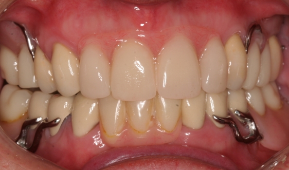 New Upper & lower part dentures