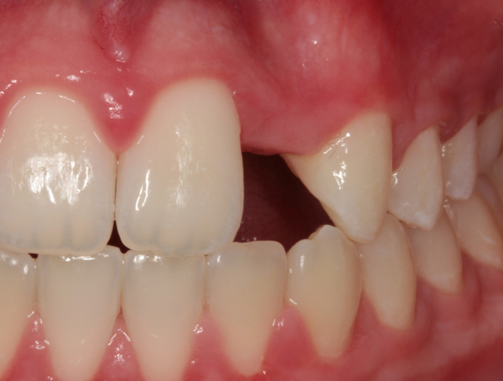 Missing Tooth Young Boy