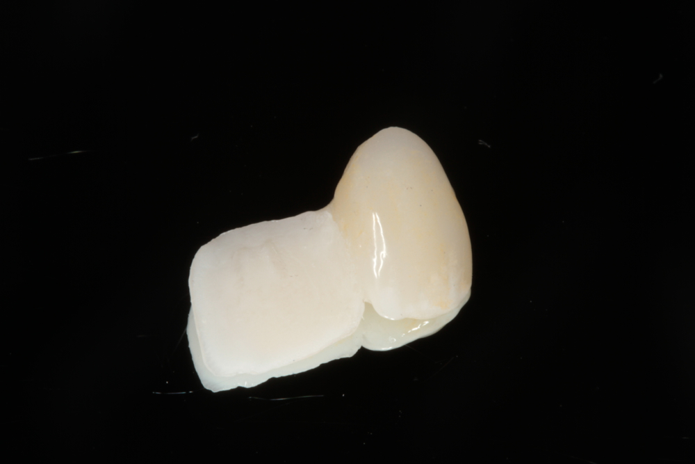 All Ceramic Bonded Bridge