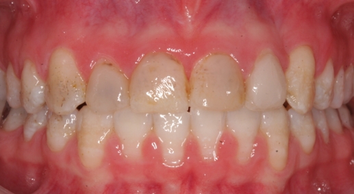 Congential Defects in tooth