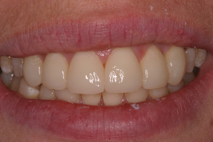 Resin Veneers to rebuild