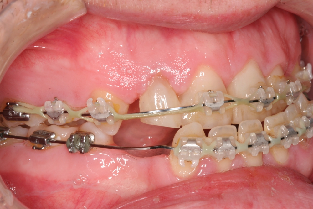 Jaw problems, Congenitally missing teeth