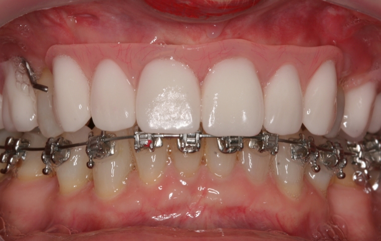 Braces, Surgery, Gum treatment