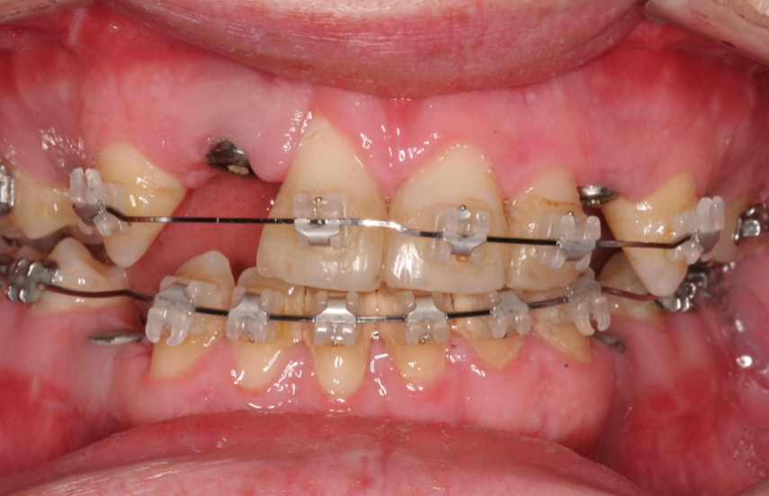 Jaw Surgery, Orthodontics